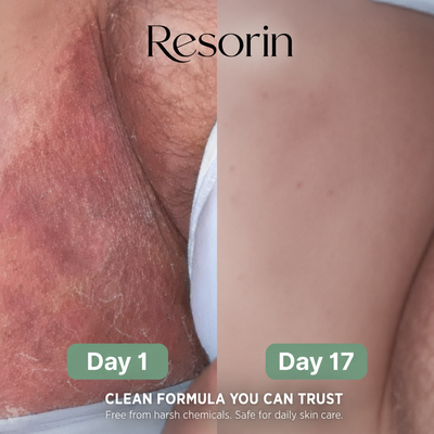 Resorin Anti-Fungal Soap